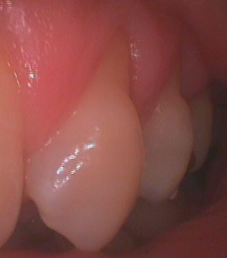 歯根が露出した上の歯