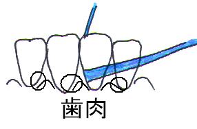 下顎前歯のフロッシング２