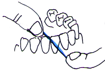 下顎前歯のフロッシング