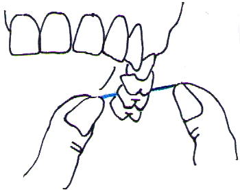 上顎臼歯のフロッシング