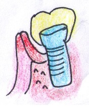 インプラント歯周炎