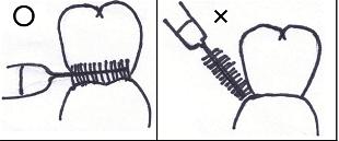 歯間ブラシの挿入方向