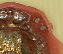 マグフィット　義歯内面
