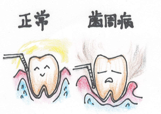 歯周基本検査と歯周精密検査