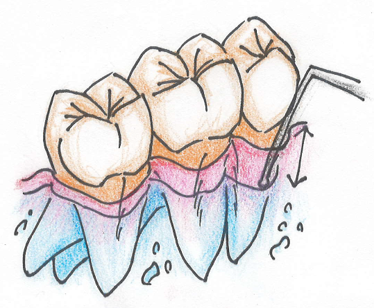 歯周基本検査と歯周精密検査