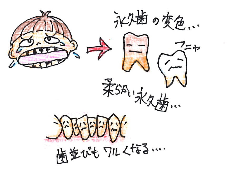 乳歯の虫歯は